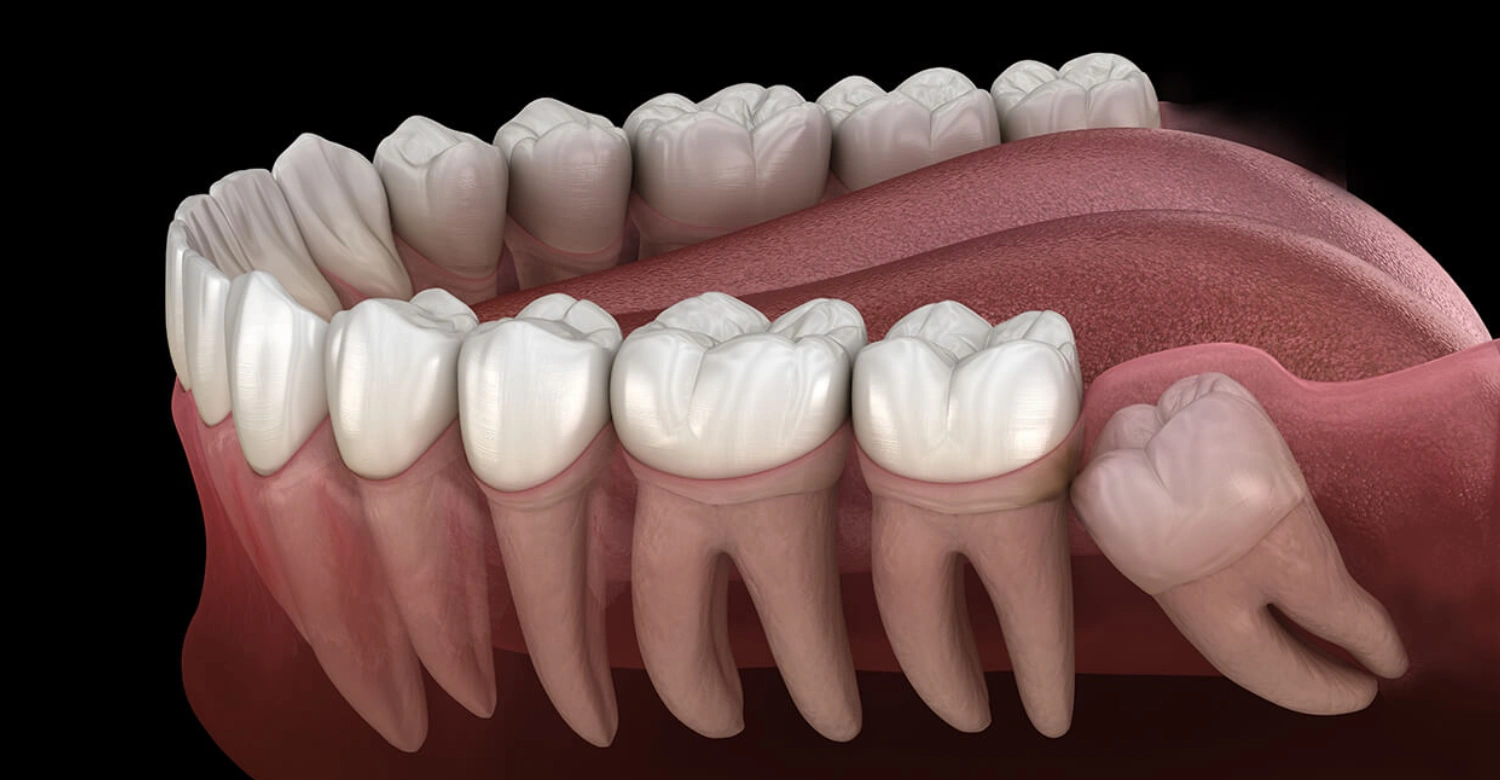 Is wisdom teeth removal orthodontic or dental inblog